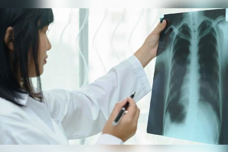 Pemerintah Tambah Anggaran Percepatan Deteksi TBC pada 2026